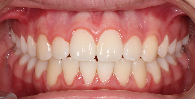 After treatment where braces were used to correct the dental alignment and occlusion (bite) between the teeth